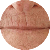 Устранение морщин вокруг рта (кисет) До