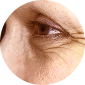 Устранение морщин вокруг глаз (гусиные лапки) До