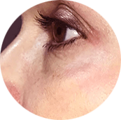 Устранение морщин вокруг глаз (гусиные лапки) ПОСЛЕ